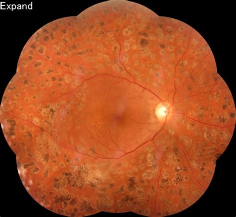 Retinopatia Diabética Oftalmologia Especializada