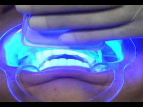 Clareamento Dental A Laser O Que E Como Funciona