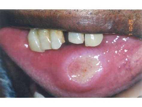 Squamous Cell Carcinoma Lip