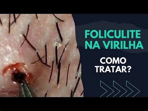 Foliculite Na Virilha Como Tratar Saiba Experimente A Emo O