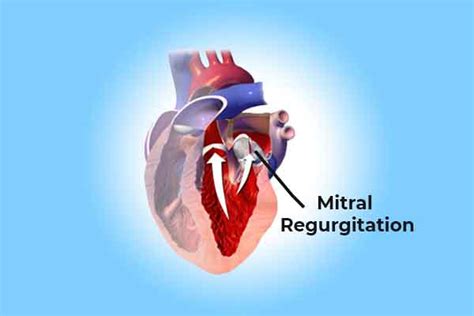 Mitral Valve Regurgitationbest Ayurvedic Doctor For Heart Disease