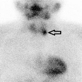 Technetium M Sestamibi Mibi Scan Showing Focal Retained Activity