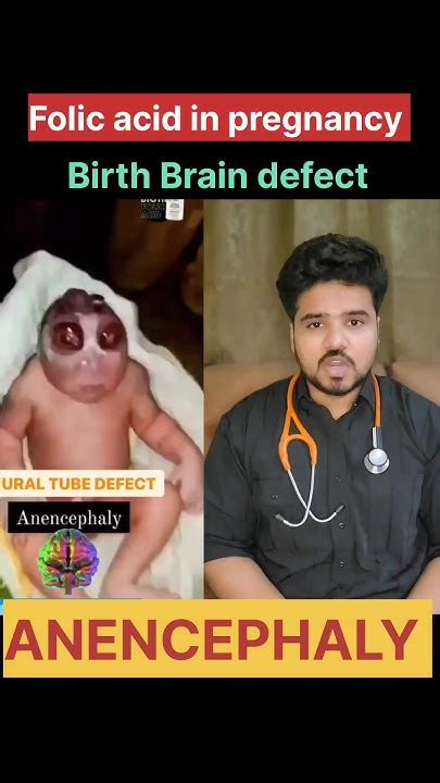 Birth Brain Defect Anencephaly Viral Trending Pediatrics Newborn Shorts Braindefect