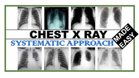 Ai Accurately Identifies Normal And Abnormal Chest X Rays 40 Off