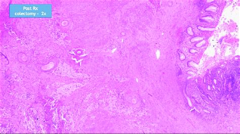 Hematoxylin And Eosin Staining Of Biopsy From The Stricture At The