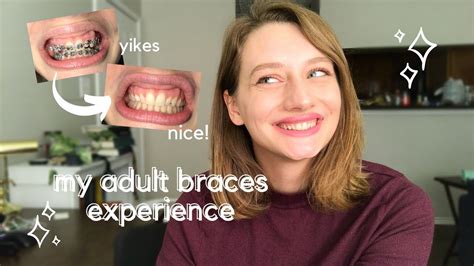 My Adult Braces Experience Deep Overbite Bite Plate Crowding Rubber Bands Youtube