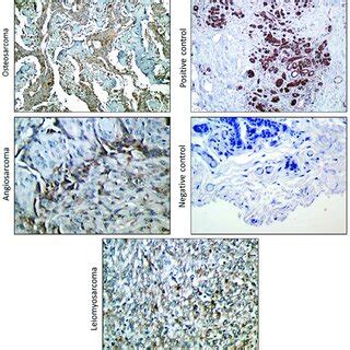 Correlation Of Epithelial Cell Adhesion Molecule Epcam Expression