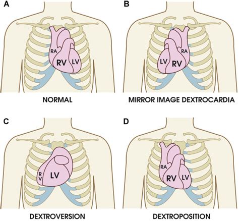 Successful Leadless Pacemaker Implantation In A Patient With