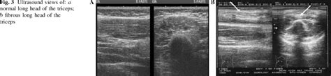 Ultrasound Views Of A Normal Long Head Of The Triceps B Fibrous Long