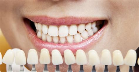 How to Whiten Bonded Teeth At Home - Tips and Techniques - Dentaly.org