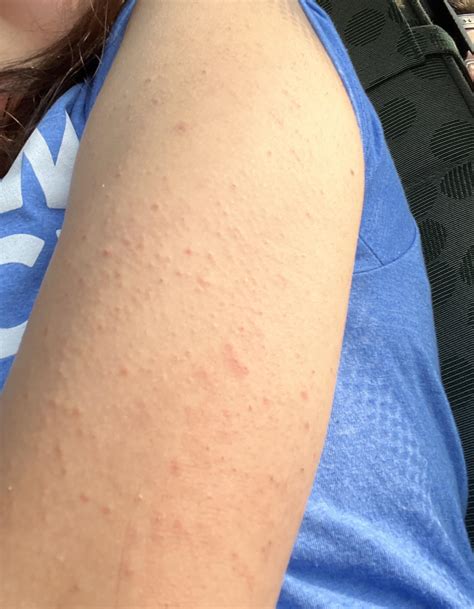 Keratosis Pilaris Bumps On Arms To Buy