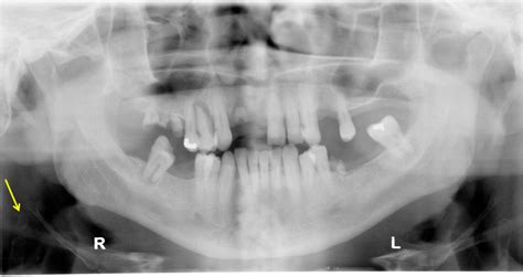 Triticeal cartilage – Dr. G's Toothpix