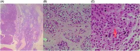 Leydig Cell Tumor Hematoxylin And Eosin Stain A Tumor Left Is