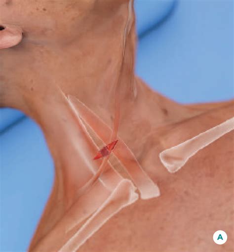 Carotid Artery Disease Treatment How TCAR Works