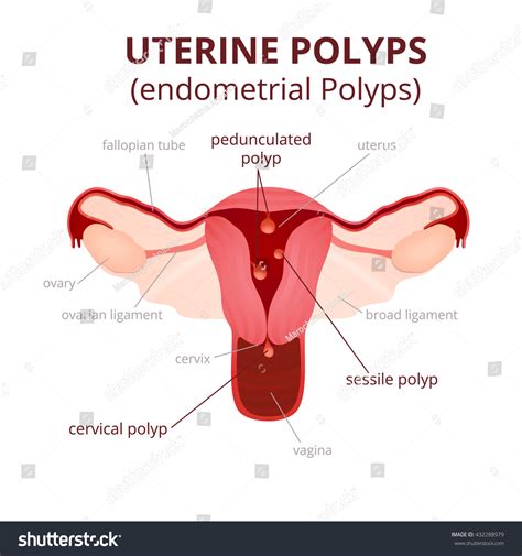 Endocervical Polyp Over 52 Royalty Free Licensable Stock Illustrations