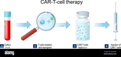 Terapia De C Lulas T Con Car Pasos Del Procedimiento M Dico Para La