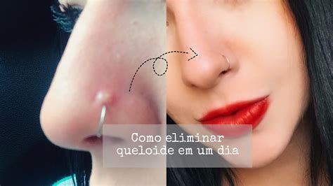 Como Acabar A Queloide Do Piercing Sharon Mel Youtube