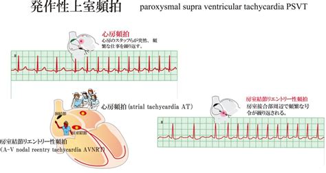 発作性上室頻拍