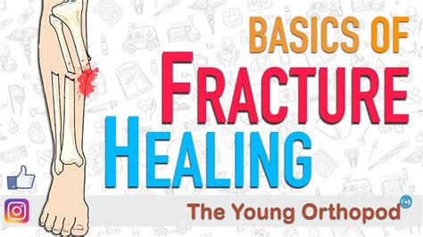 Fracture Healing Animation Basics The Young Orthopod Youtube