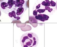 Leukocyte Abnormalities Infectious Agents Clinical Pathology