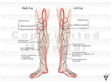 Stock Lower Limb Clots Plaques In Vasculature Illustrated Verdict