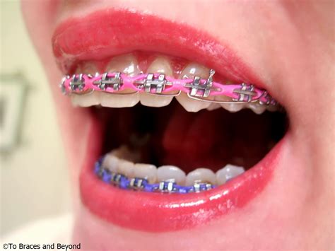 Pin By J T On Braces Braces Girls Cute Braces Colors Braces Colors