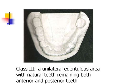 Classification Of Partially Edentulous Archesppt