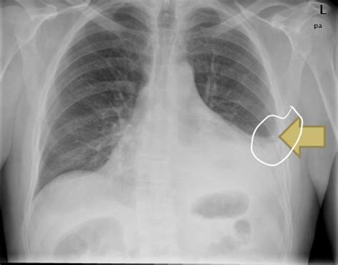 Pleural Effusion Flashcards Quizlet