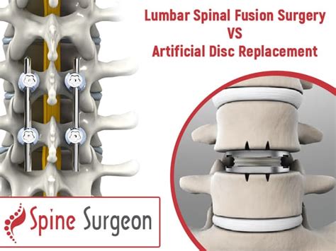 Lumbar Spinal Fusion Surgery