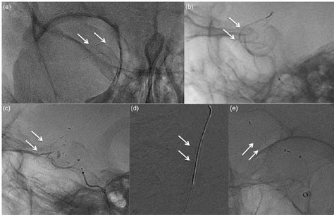 Flow Diverter Devices Approved For The Treatment Of Intracranial