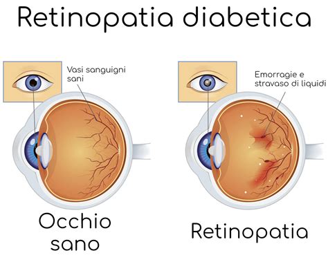 Retinopatia Diabetica Cause Sintomi E Cura Valori Normali