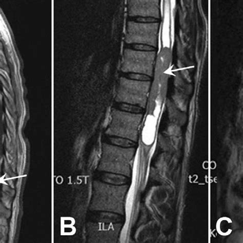 Preoperative Sagittal Post Contrast T1 Weighted Mri Of The Spine