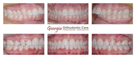 Class Ii Division 1 Teeth