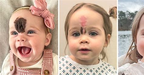 Parents Sent Daughter To Surgery To Remove Rare Birthmark People