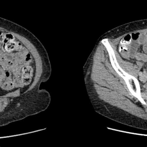 Ct Abdomen Pelvis December Demonstrating Complex Multi Septated