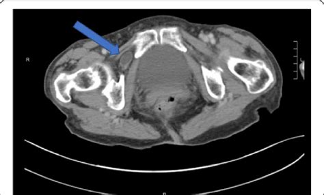 Axial Computed Tomography Image Showing A Right Sided Obturator Hernia