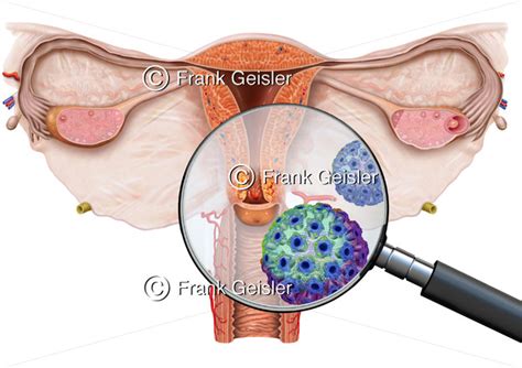 Uterus Mit Geb Rmutterhalskrebs Zervixkarzinom Carcinoma Cervicis