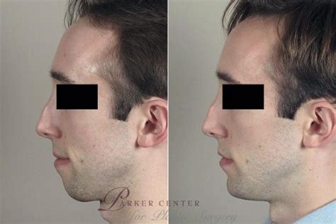 Chin Implant Before And After Pictures Case 256 Paramus New Jersey Parker Center For