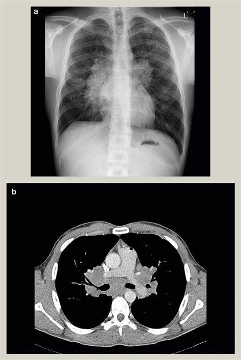 Pulmonary Sarcoidosis Medicine