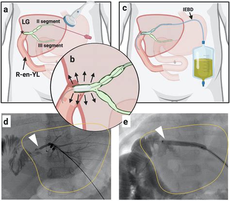 Percutaneous Transhepatic Cholangiography Ptc A D Liver Puncture