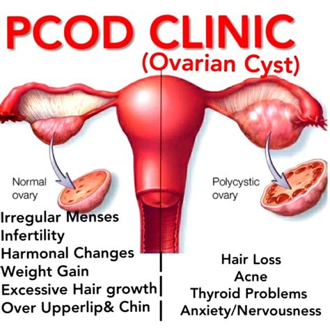 Best Treatment For Pcod Pcos In New Sangvi Causes Treatments