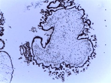 Borderline Ovarian Serous Tumor Wt1 Diffuse Positive In Tumor Cells