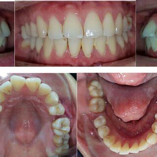 Intraoral photographs before treatment. | Download Scientific Diagram
