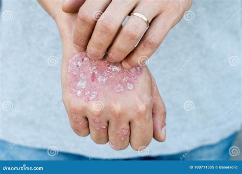 Sirva El Rasgu O Piel Escamosa Seca A Mano Con El Psoriasis Vulgaris