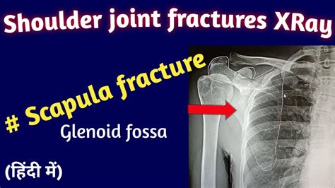 How To Read Shoulder Joint Fracture X Ray Scapula Fracture Xray