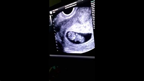 9 Weeks 4 Days Pregnant Ultrasound Youtube