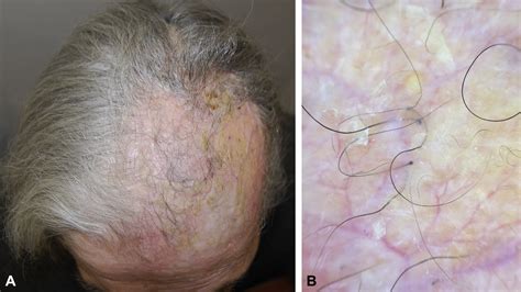 Erosive Pustular Dermatosis Of The Scalp Clinical Trichoscopic And