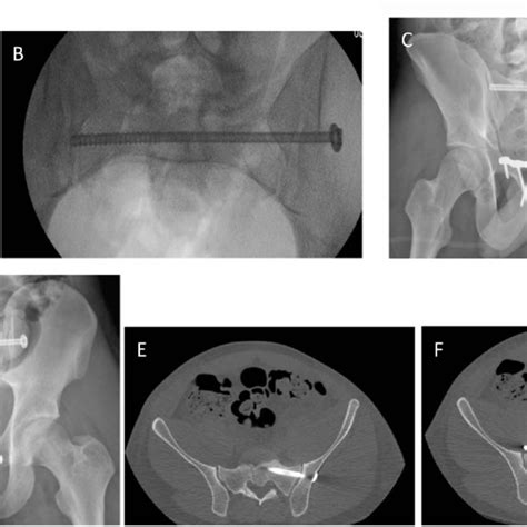 A Intraoperative Fluoroscopic Lateral Sacral View Showing Trajectory