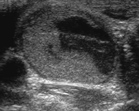 Medullary Carcinoma Thyroid Ultrasound