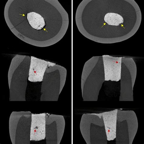 Representative Micro CT Images From Top To Bottom Axial Coronal And